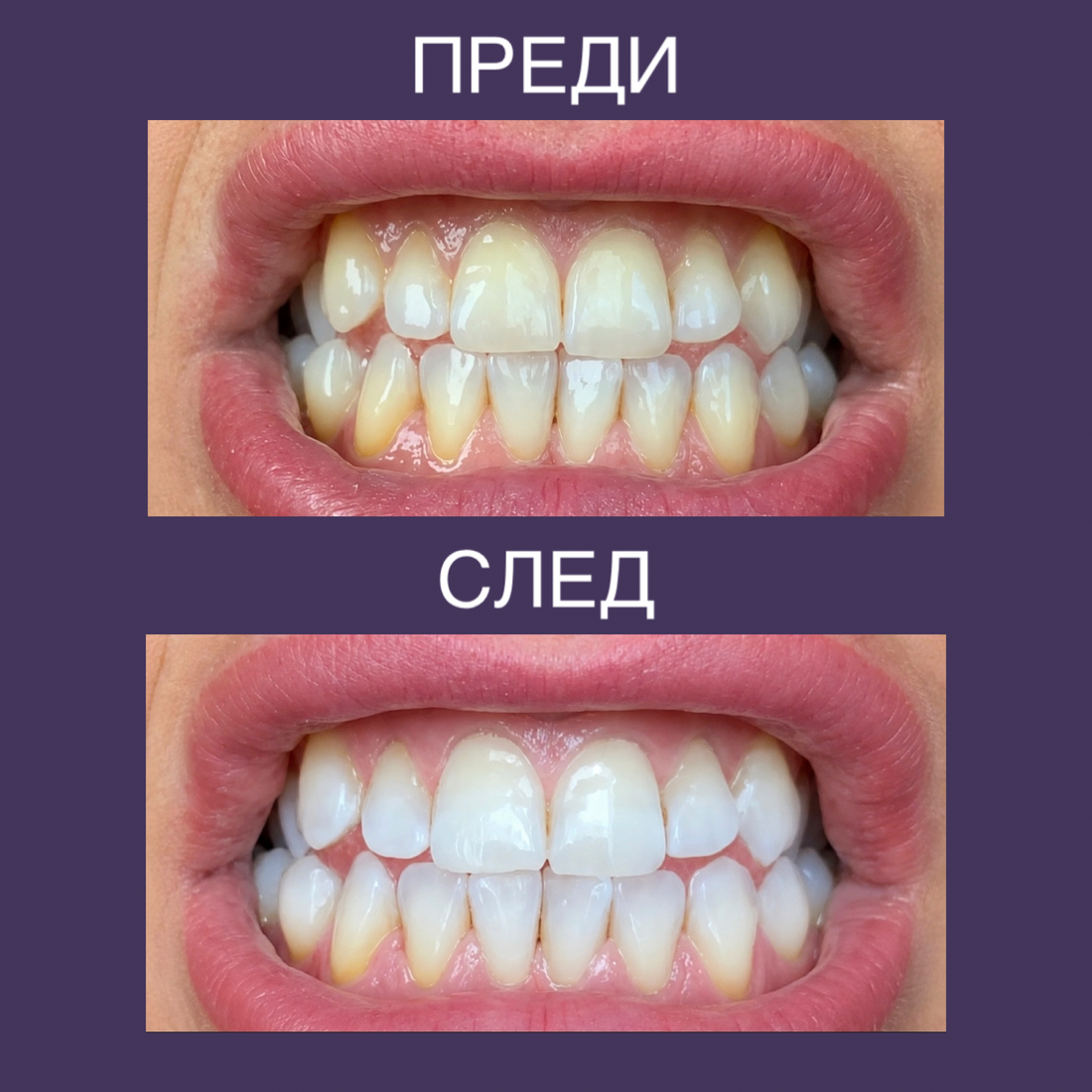 GlowBite Избелващи лентички за зъби
